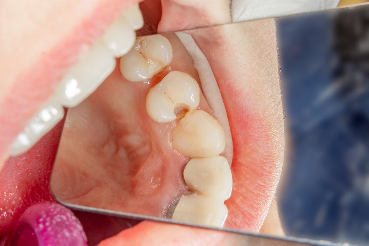 Descubre cómo prevenir y tratar los dientes picados: la guía definitiva